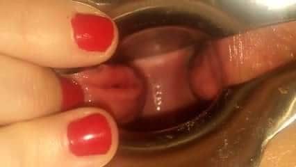 Speculum opeing the vagina and Peehole destruction