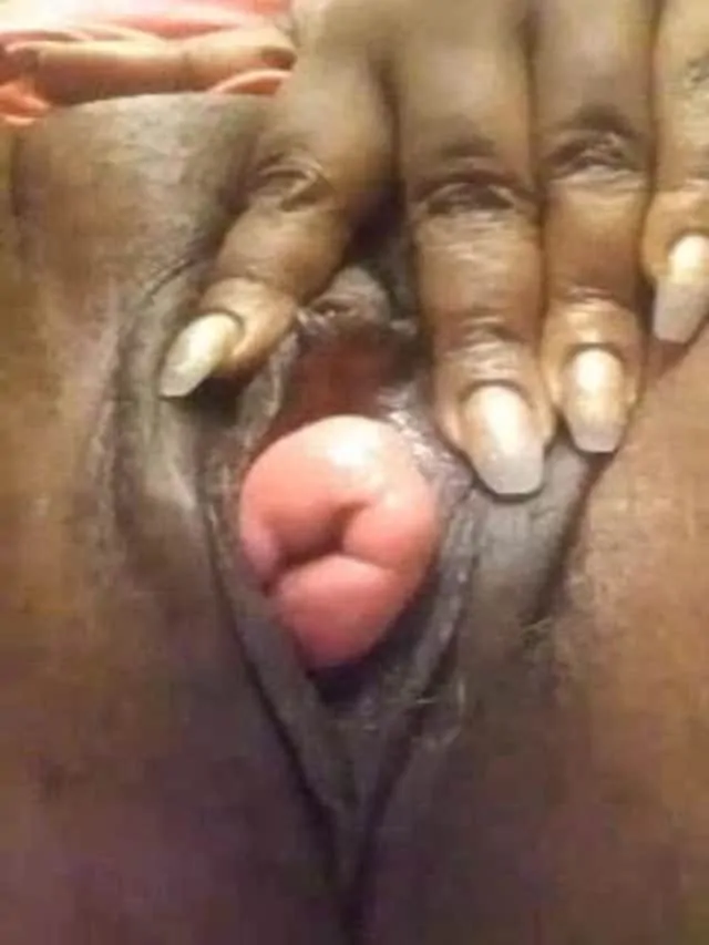 The biggest cervix prolapse ever?