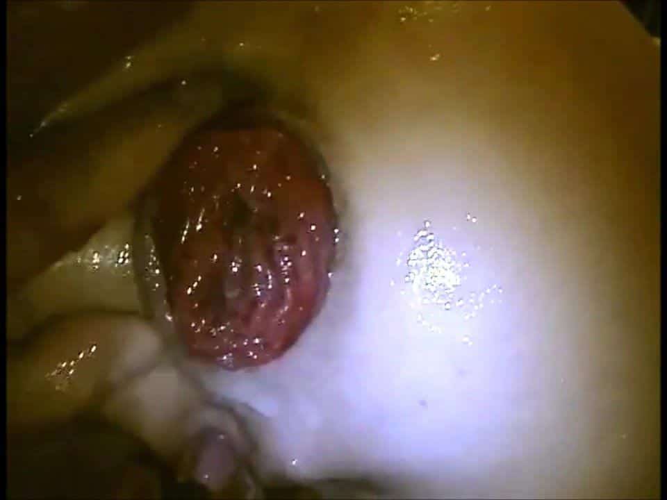 Wife is fisted until she prolapses