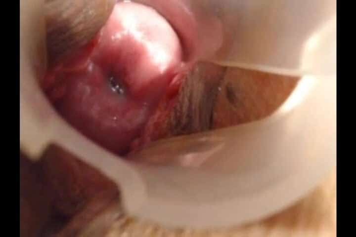 Cervix insertion with a pen!