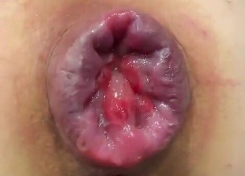 M687pro giant and very wide prolapse