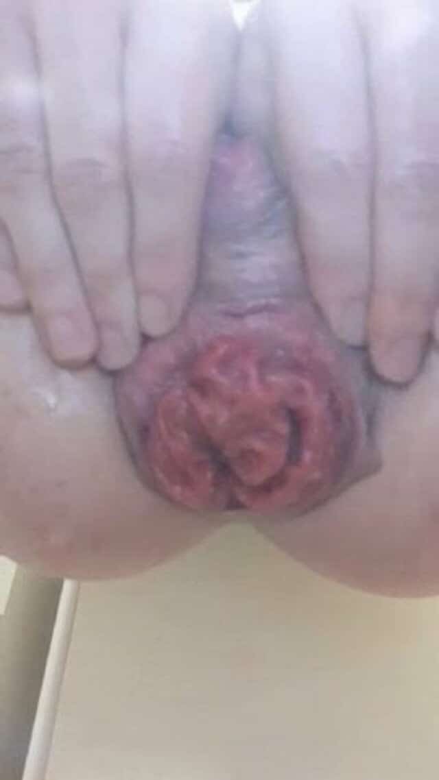 Nice anal prolapse