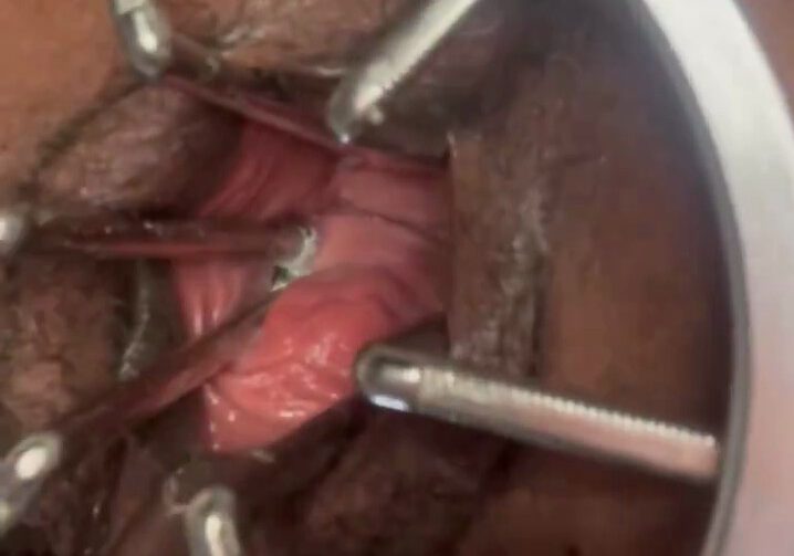 ExtremeNonye stretching her huge vagina